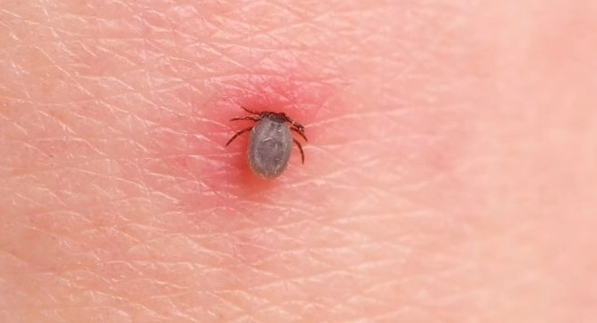 牛蜱會進入人體皮膚内進食同時傳播疾病